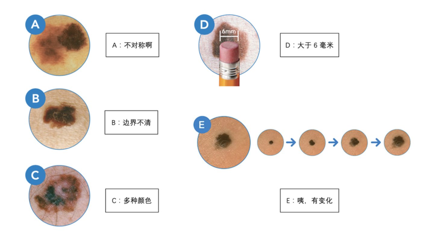 你身上的痣，癌变可能有多大